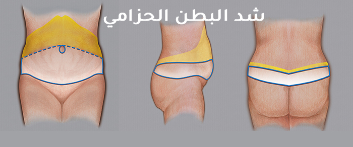 تعليمات بعد عملية شد البطن الحزامي