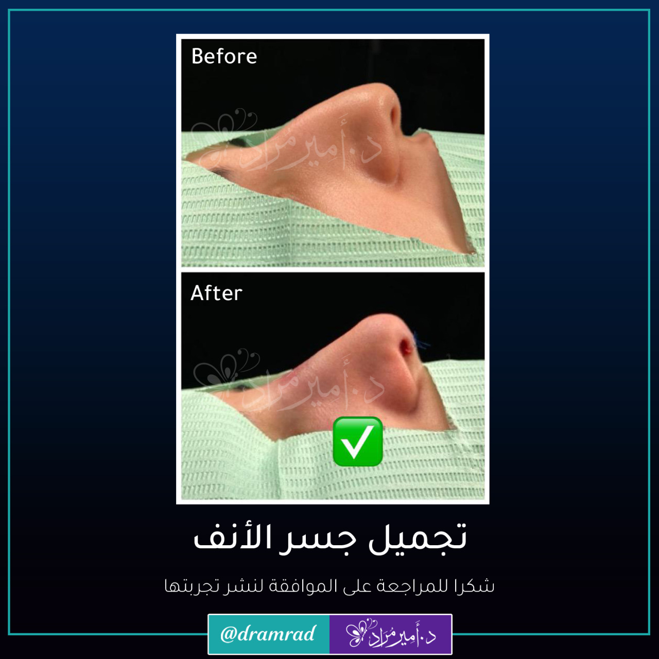 تجميل جسر الأنف قبل وبعد عملية تجميل الأنف مع د. أمير مراد