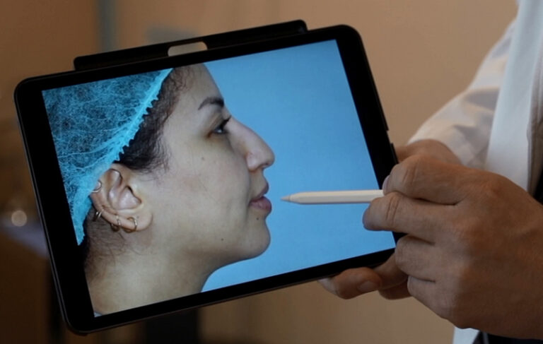 Nose Surgery dr amir mrad