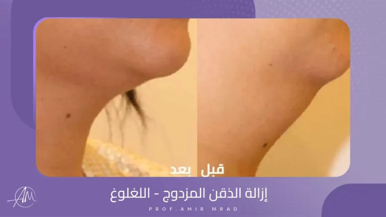 إزالة الذقن المزدوج - اللغلوغ