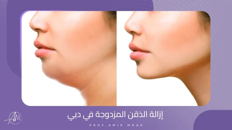 إزالة الذقن المزدوجة في دبي