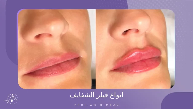 انواع فيلر الشفايف