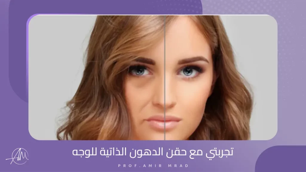 تجربتي مع حقن الدهون الذاتية للوجه