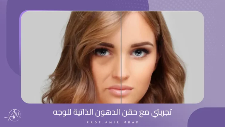 تجربتي مع حقن الدهون الذاتية للوجه