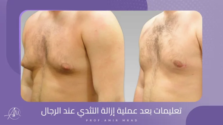 تعليمات بعد عملية إزالة التثدي عند الرجال