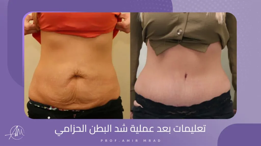 تعليمات بعد عملية شد البطن الحزامي