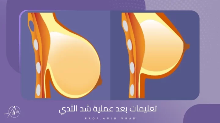 تعليمات بعد عملية شد الثدي