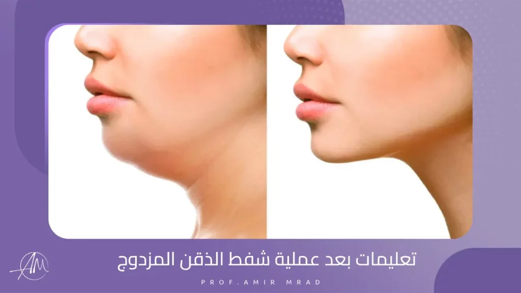 تعليمات بعد عملية شفط الذقن المزدوج