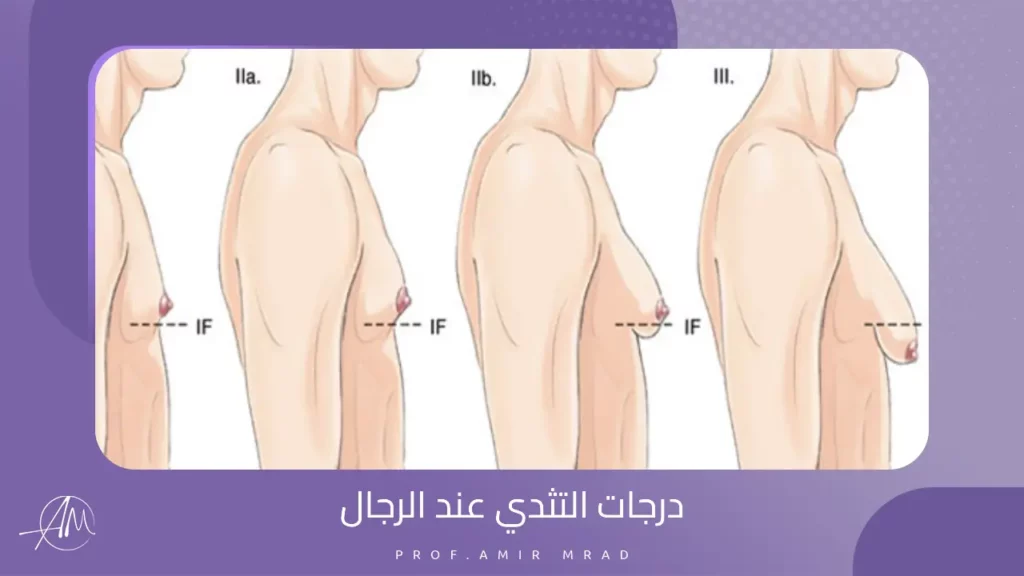 درجات التثدي عند الرجال