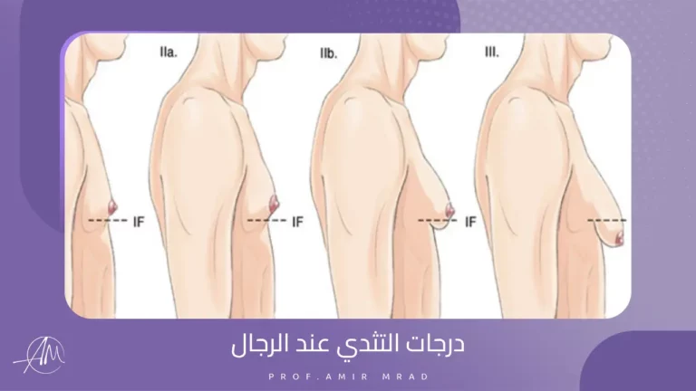 درجات التثدي عند الرجال