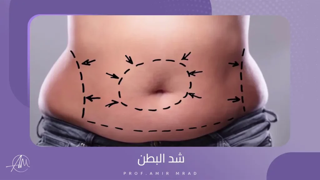 شد البطن