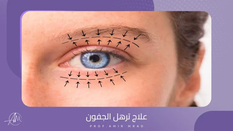 علاج ترهل الجفون