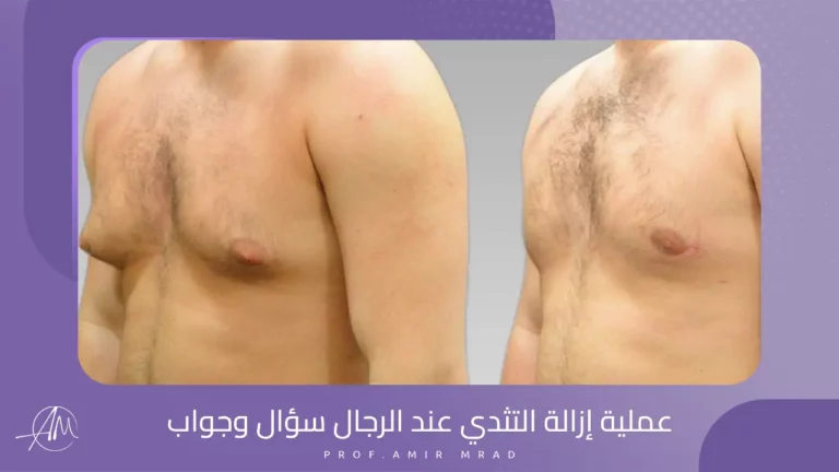 عملية إزالة التثدي عند الرجال سؤال وجواب