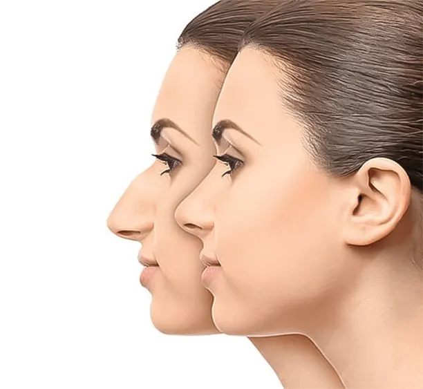 عملية تجميل الأنف