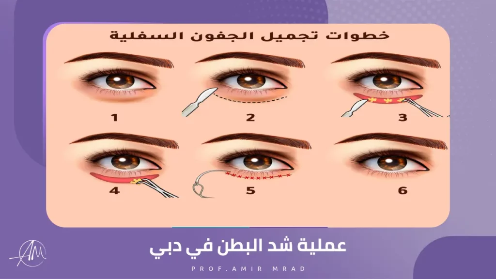 عملية تجميل الجفون السفلية سؤال وجواب