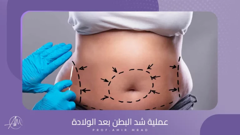 عملية شد البطن بعد الولادة