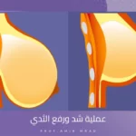 عملية شد ورفع الثدي