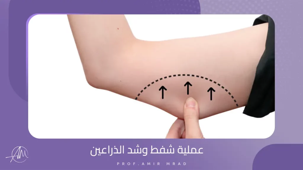 عملية شفط وشد الذراعين