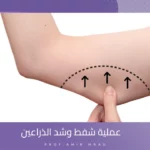 عملية شفط وشد الذراعين
