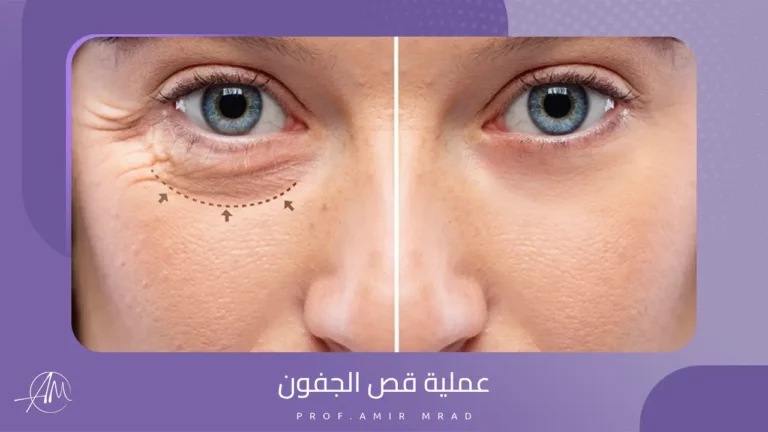 عملية قص الجفون