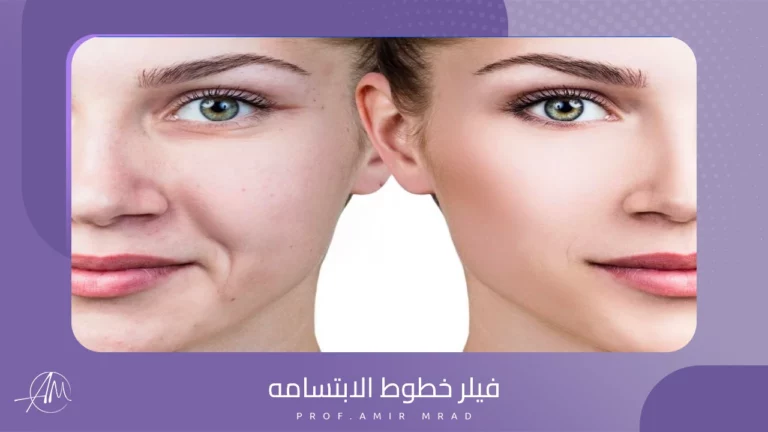 فيلر خطوط الابتسامه