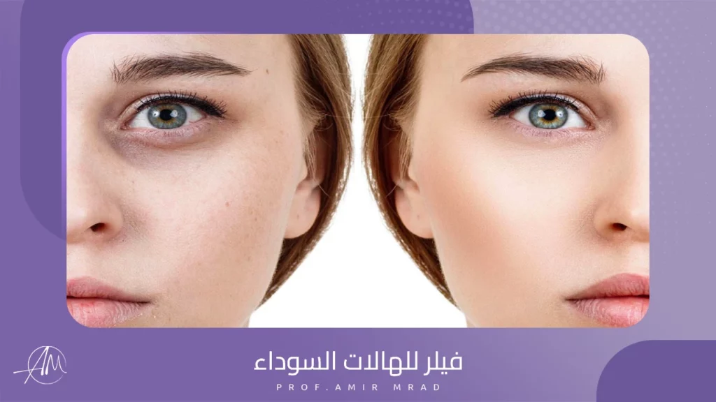 فيلر للهالات السوداء