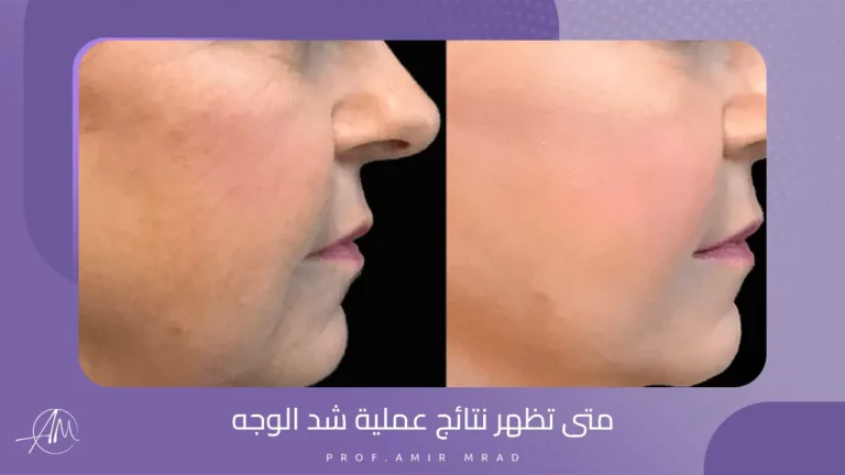 متى تظهر نتائج عملية شد الوجه