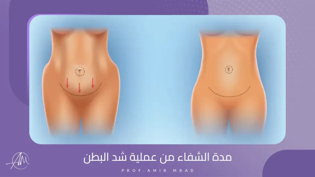 مدة الشفاء من عملية شد البطن