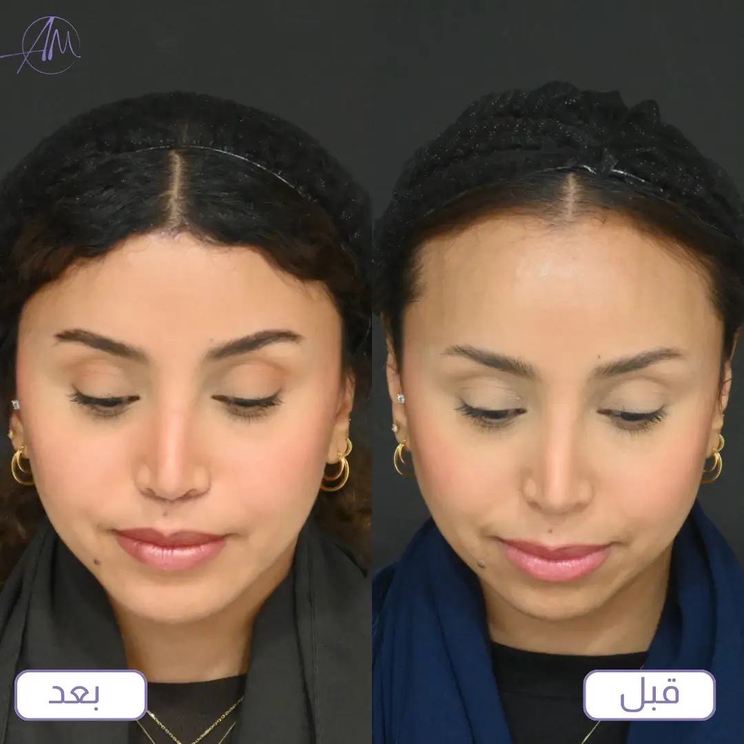 تجارب المرضى مع عملية تصغير الجبهة قبل وبعد