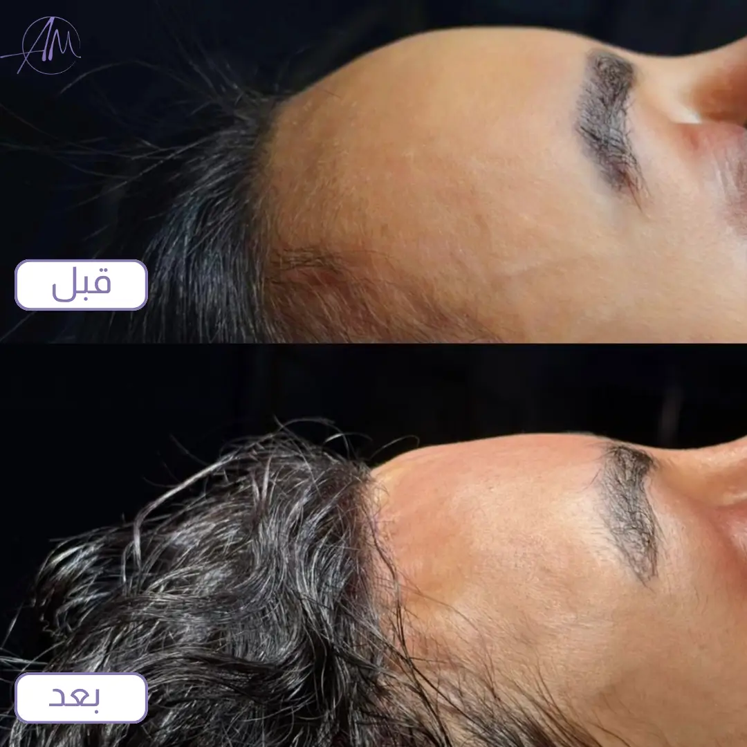 ندبة عملية تصغير الجبهة عند خط الشعر قبل وبعد الالتئام