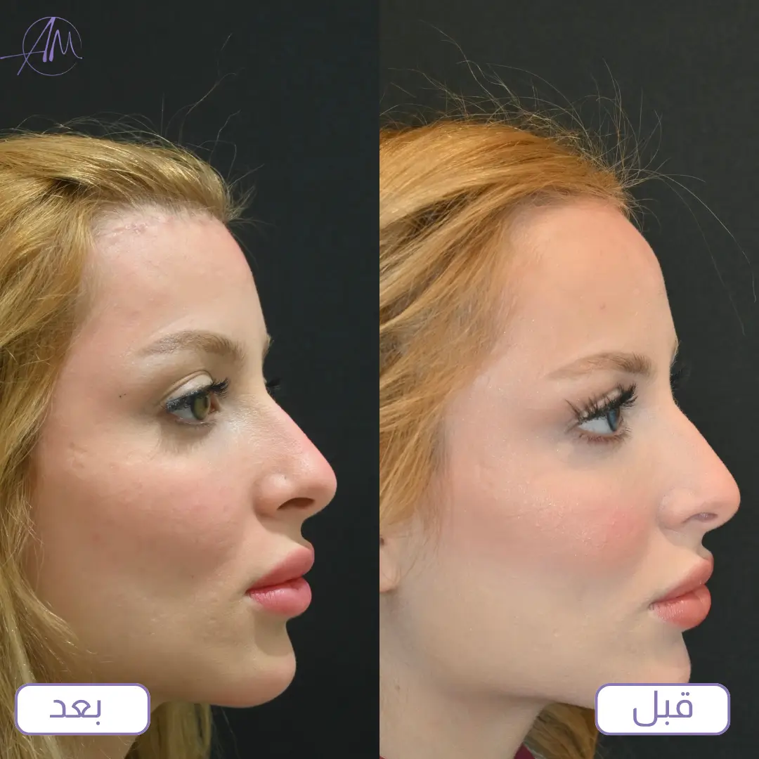 نتيجة تصغير الجبهة جراحيًا من الجانب قبل وبعد