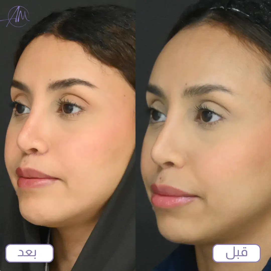 صور عملية تصغير الجبهة قبل وبعد لإحدى المريضات