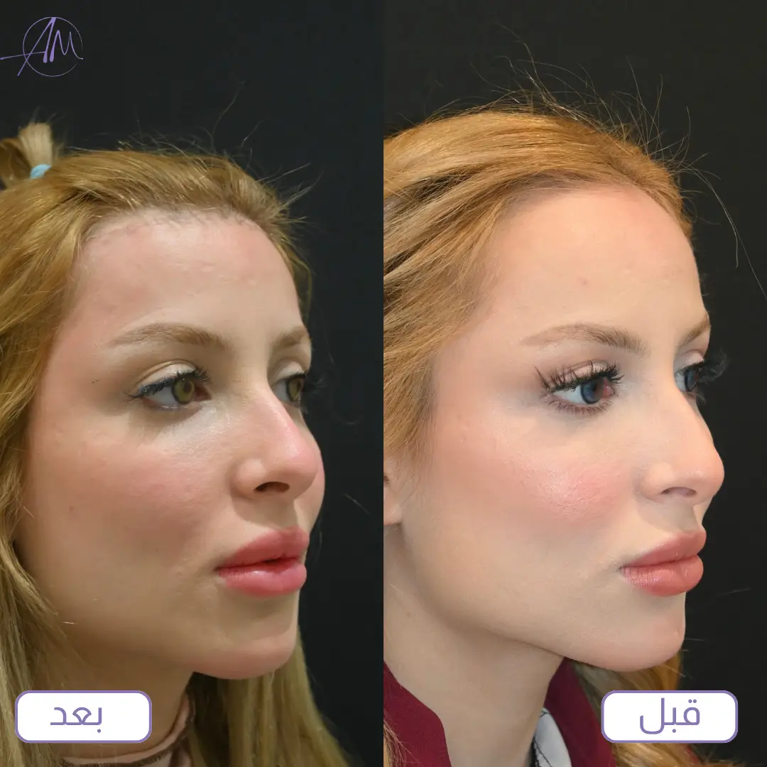 نتائج عملية تقصير الجبهة قبل وبعد