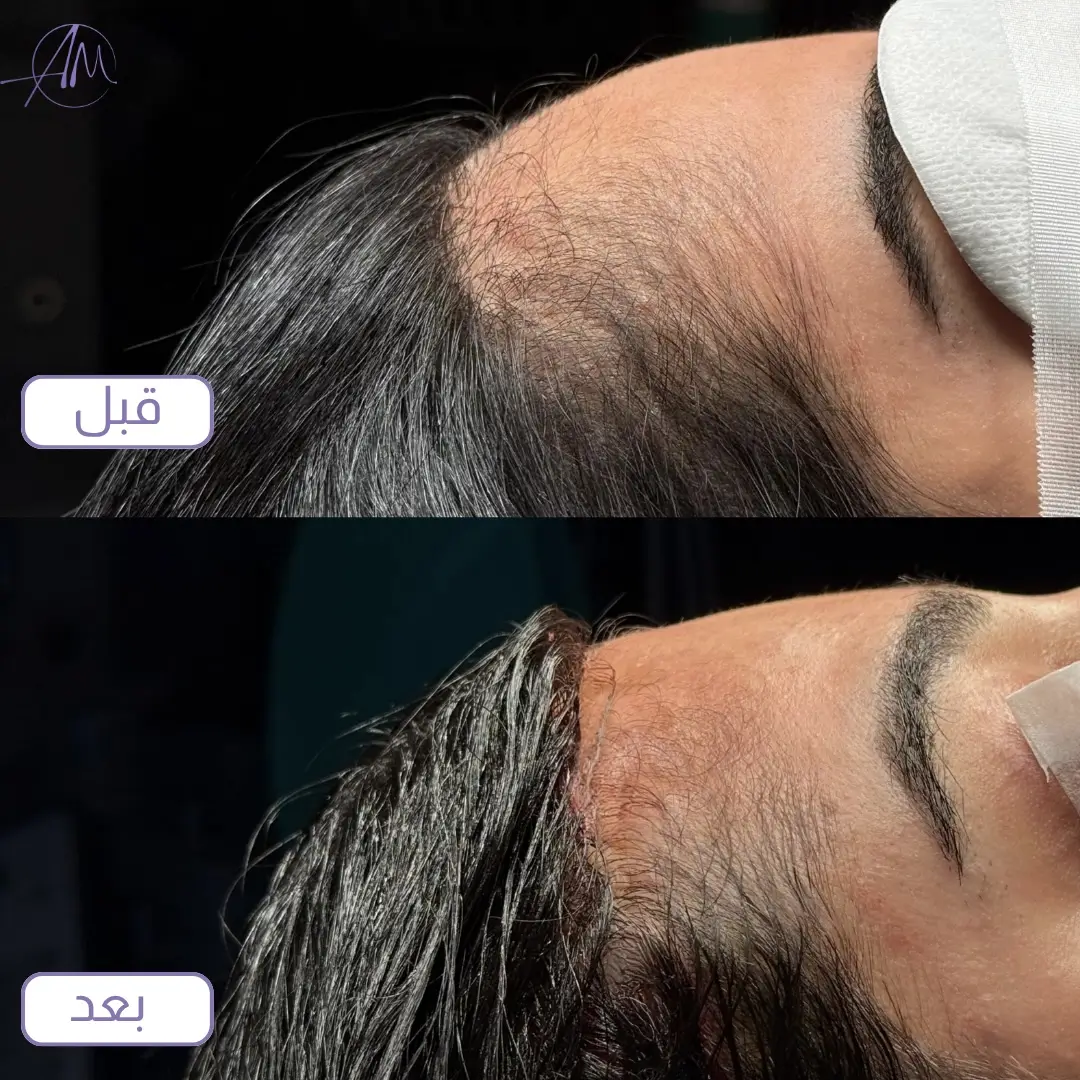 نتيجة عملية تصغير الجبهة قبل وبعد بتقديم خط الشعر لدى البروفيسور أمير مراد