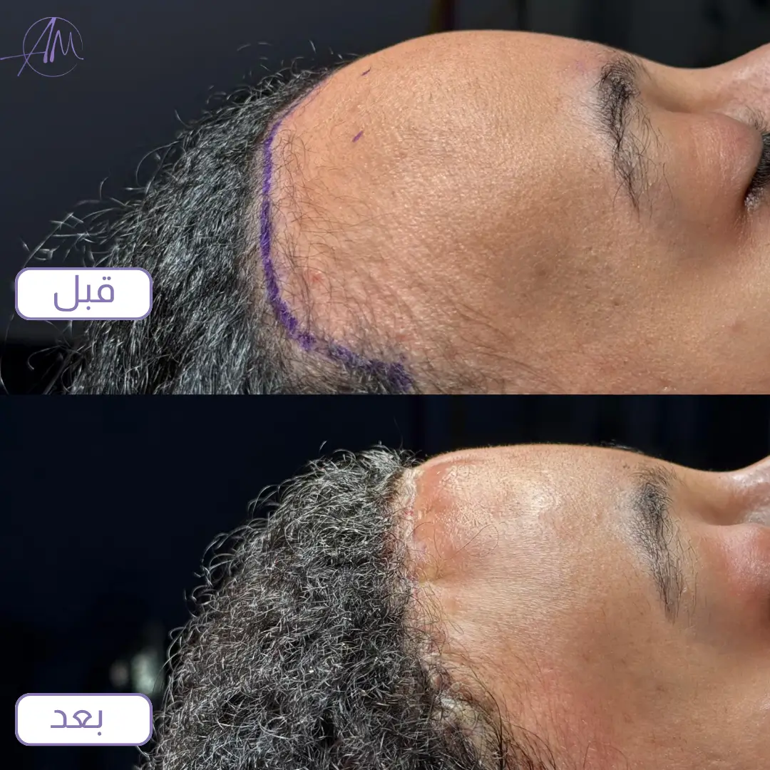 تحديد خط الشق الجراحي في عملية قص الجبهة قبل وبعد